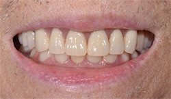 症例　「総入れ歯」の作り変え